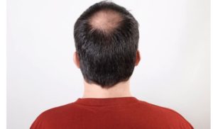 Saç Kaybı Sizi Nasıl Etkiliyor? Çözümü Nedir?